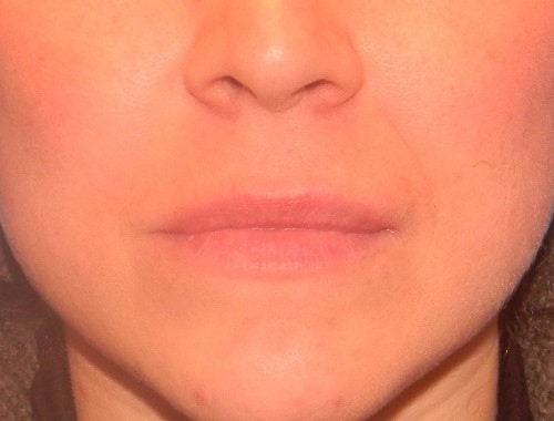 aumento de labios en madrid permalip
