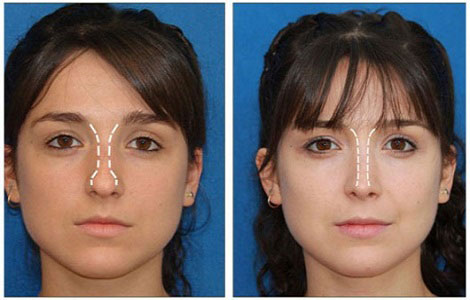mini lifting facial antes y después scapă de ridurile de pe puntea nasului