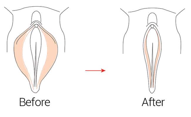Vaginoplastia: Cirugía Estética Vaginal