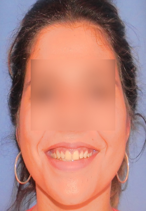 Operacion de orejas otoplastica clinica doctor sarmentero madrid cirugia plastica y estetica 2 fin