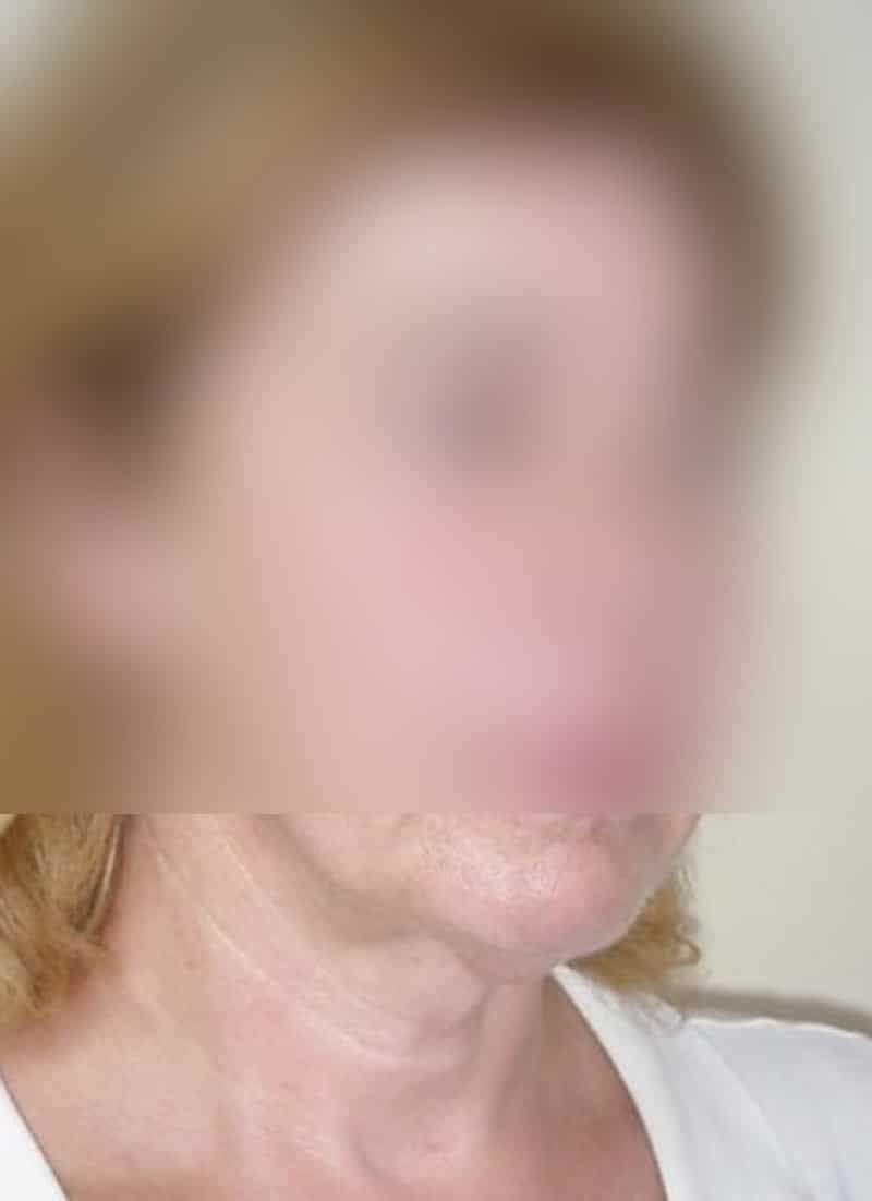 Platisma rejuvenecimiento de cuello doctor sarmentero cirugia plastica y estetica madrid 2