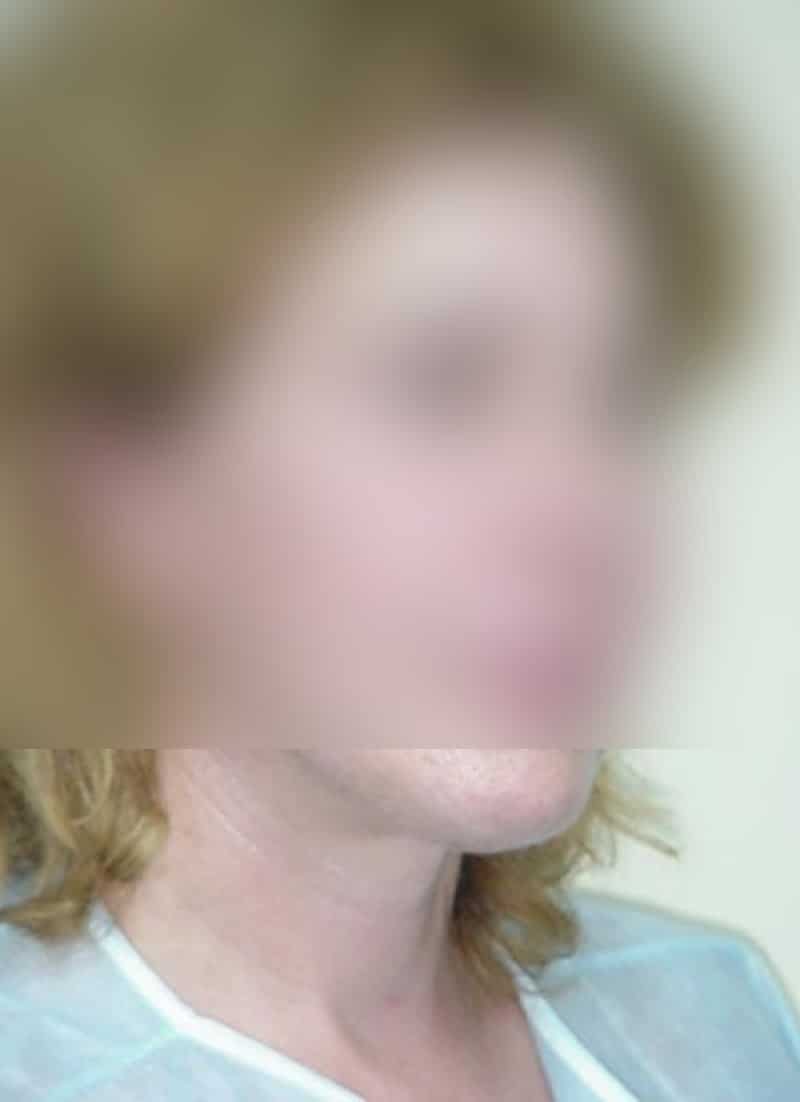 Platisma rejuvenecimiento de cuello doctor sarmentero cirugia plastica y estetica madrid 22