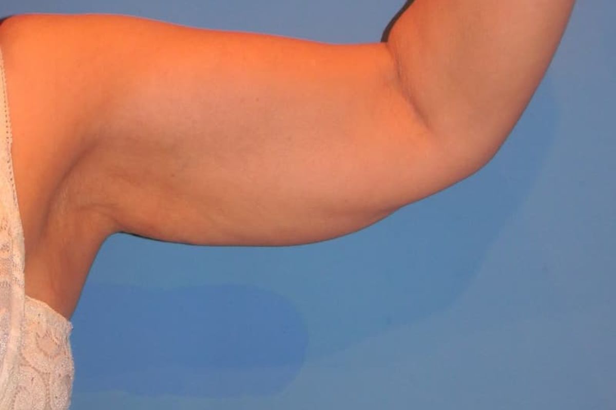 braquioplastia