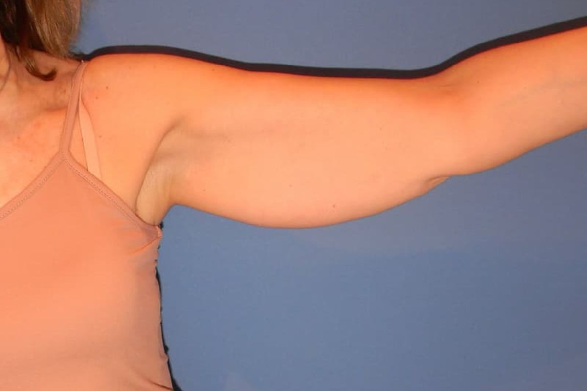 braquioplastia antes