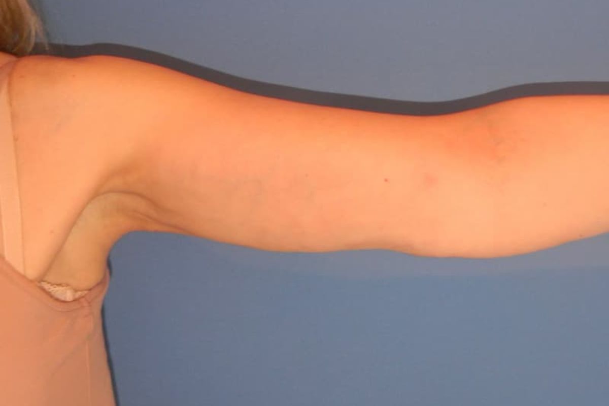 braquioplastia despues
