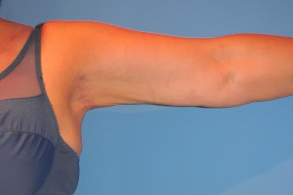 operacion_braquioplastia